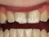 Что делать если отвалился кусок зуба