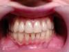 Zánět sliznice dutiny ústní: příznaky a léčba