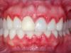 Inflammation of the gums near the tooth: treatment and prevention