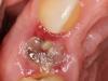 Tratamiento de la inflamación de las encías después de la extracción del diente.