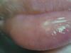 Perubahan dalam mukosa mulut dalam penyakit alahan