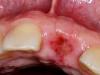 Apakah komplikasi yang boleh berlaku selepas pengekstrakan gigi?