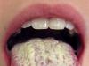 Lapisan oranye di lidah: penyebab dan pengobatan