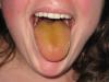 What does a yellow coating on the tongue indicate?