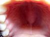 मुंह की छत में दर्द होता है: कारण और उपचार क्या हैं?
