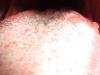 Dilin kökündeki beyaz plak: nedenleri