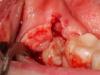 Recomendaciones después de la extracción dental: ¿cuándo se puede comer y cepillarse los dientes?