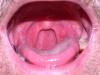 Tell me, my palate is inflamed, what to do?
