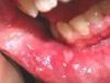 Çocuğun dilindeki kırmızı lekelere ne sebep olur ve nasıl tedavi edilir?