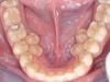 Քանի՞ հիմնական և մշտական ​​ատամ պետք է ունենան երեխան և մեծահասակը: