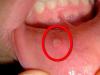 الهربس في فم الطفل: الأعراض والعلاج