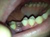 کشیدن دندان: نحوه از بین بردن تورم