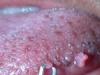 Síntomas del cáncer bucal: cómo reconocerlos a tiempo