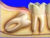 Berapa lama gigi bungsu tumbuh, apakah perlu dicabut?