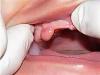 Pertumbuhan putih pada gusi setelah pencabutan gigi