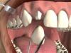 The gums around the tooth under the crown are inflamed and bleeding: what to do and how to treat