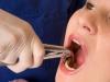 Apa yang harus dilakukan jika setelah pencabutan gigi telinga Anda sakit dan ada tunas di pelipis