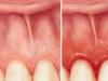 Swollen gums - causes, treatment methods and prevention
