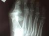 Cómo tratar la artritis de los dedos de los pies.