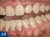 Gingivitis - the main forms and methods of effective treatment