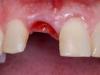 Extrakce zubu: co dělat po?