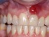 Nebezpečný jev, který doprovází zánětlivé procesy - píštěl na dásních: fotografie, příčiny a léčba patologického procesu