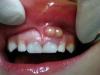 Tooth cyst - what is it, how to treat?