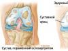 Artritis de la articulación de la rodilla: síntomas y tratamiento de la enfermedad.