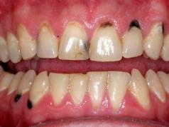 Ատամների կոշտ հյուսվածքների նեկրոզ