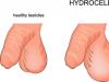 Léčba testikulární hydrokély nebo hydrokély u dětí