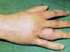 આંગળી પર પેનારીટિયમ - કારણો, લક્ષણો, નિદાન, સારવાર અને નિવારણ