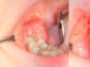 Should I remove or treat my wisdom tooth?