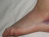Rotura del ligamento del tobillo: grados, causas, síntomas, métodos de tratamiento.