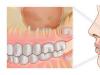 Quiste en el diente: ¿tratamiento o extracción?