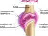 Upala zglobova: kako liječiti artritis i ublažiti simptome upale?