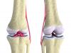 تلف القرن الخلفي للغضروف المفصلي الإنسي ماذا يعني تمزق قرون الغضروف المفصلي لمفصل الركبة؟