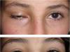 Facial anatomy: area around the eyes, upper and lower eyelids