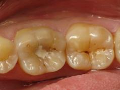 Causas y síntomas de caries debajo del empaste, tratamiento de daño dental secundario Tratamiento de caries secundaria