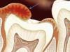 શાણપણના દાંતના હૂડની બળતરા: કારણો, સારવાર