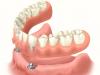 Сучасні види протезування зубів