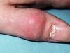 How to treat panaritium on a finger: the most effective treatment methods