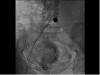 Dzemdes artēriju embolizācija dzemdes fibroīdiem