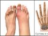 Artritida prstů na nohou: příznaky a léčba léky