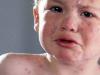 Багатоликий герпес: протікання вірусу у дитини
