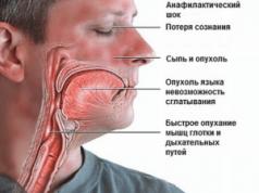 Przyczyny szoku anafilaktycznego