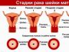 गर्भाशय ग्रीवा का क्षरण और कैंसर