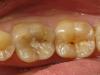 Penyebab dan gejala karies di bawah tambalan, perawatan kerusakan gigi sekunder Perawatan karies sekunder