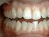दांतों में सड़न कैसी दिखती है दंत क्षय क्या है