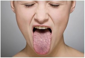 Симптомы повышенное давление сухость во рту